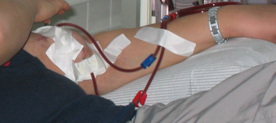 Fistule dialyse